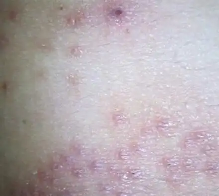 疥疮最好的诊疗方案:用硫软膏脖子以下全身涂抹,不管有没有症状的部位