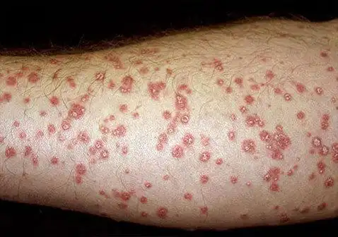 牛皮癣银屑病分哪几种类型及图片样子?