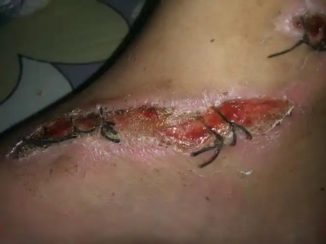 摔伤缝针伤口是否能下地走路