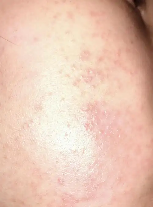 有图慎入,脸上突然长了小疱疹要用什么药膏啊啊啊.