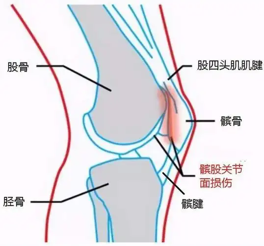 运动跑步膝外侧疼痛不能只放松髂胫束