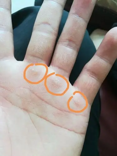 请问我手心上皮肤的这几个是什么?(我圈出的那几个)