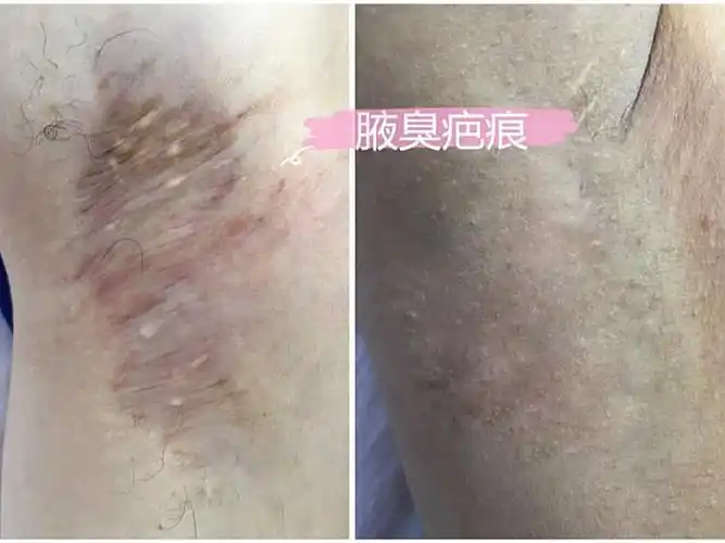 术前诊断患者情况:修复腋臭疤痕,可见患者手术后明显_圈子-新氧美容