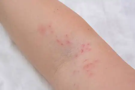 症状的妇女,搔着脖子男孩在他的身体矢量挠发痒的皮疹身体部位牛皮癣