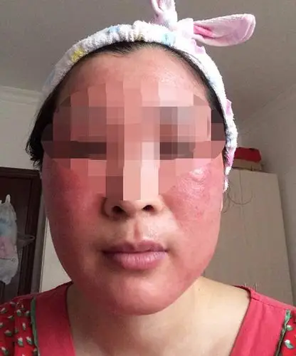 用2次脸肿5个月!"微信好友"的化妆品你还敢用?