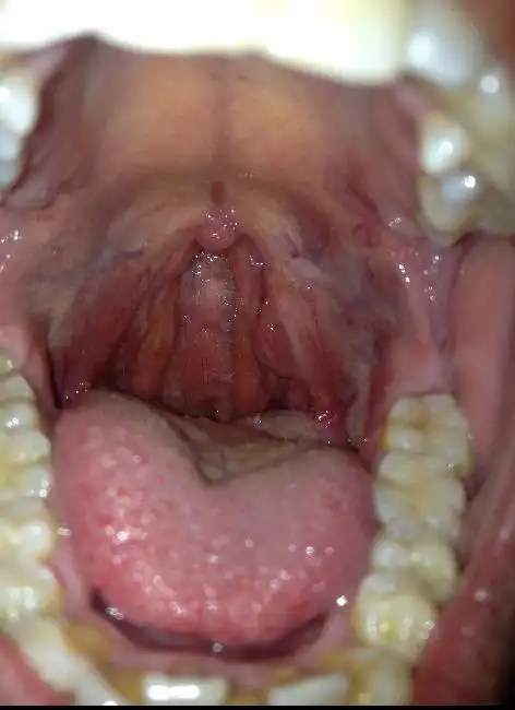 每个人的咽喉形状都不一样吗,我感觉我的和别的都不一样啊 大家帮我