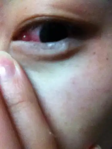 眼角红肿化脓 眼皮起包 痒痛