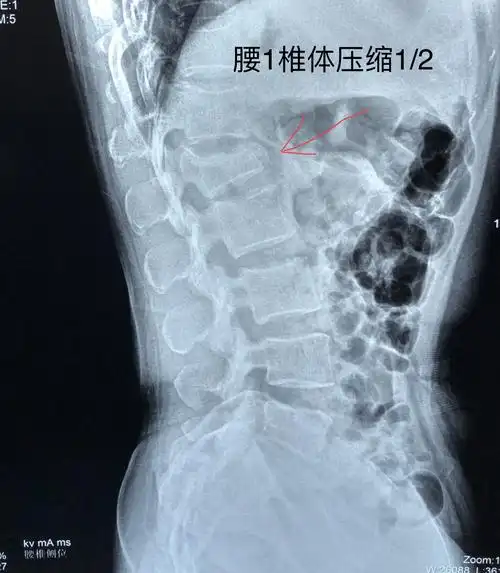 腰椎骨折早期手术干预,可达到很好的恢复效果 - 好大夫在线