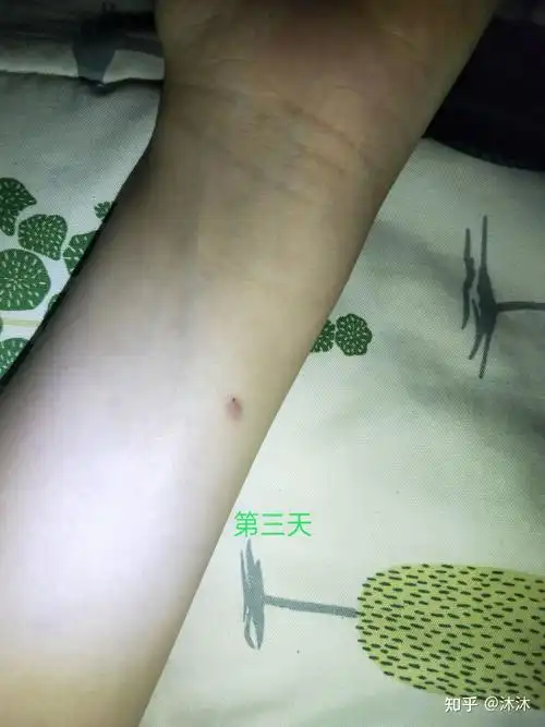 肺结核ppd皮试 - 知乎