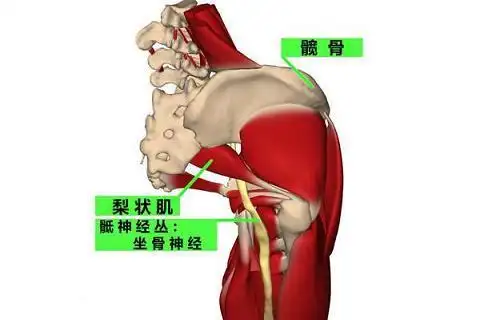 梨状肌综合征的表现有哪些及如何治疗