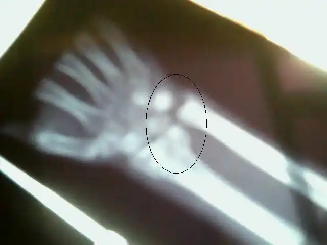 手腕错位需要做手术吗 不做手术怎么治疗