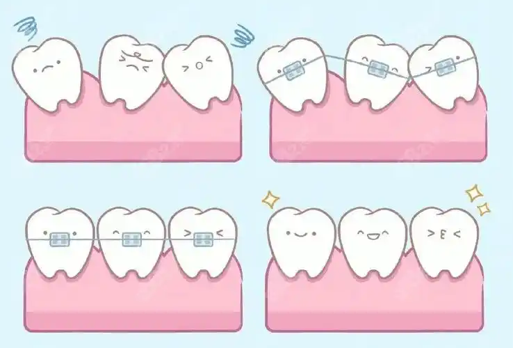 湖州吴兴区牙齿矫正多少钱时代天使隐形矫正费用也说下吧