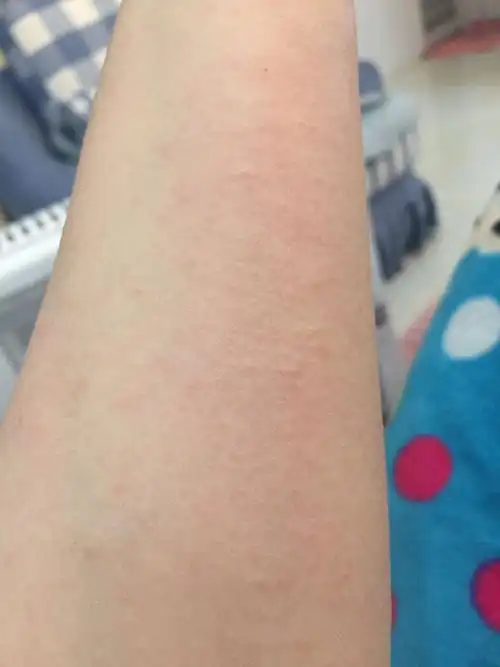 我的手臂是怎么回事,好痒,一抓就起米米,红色的疙瘩,在线等
