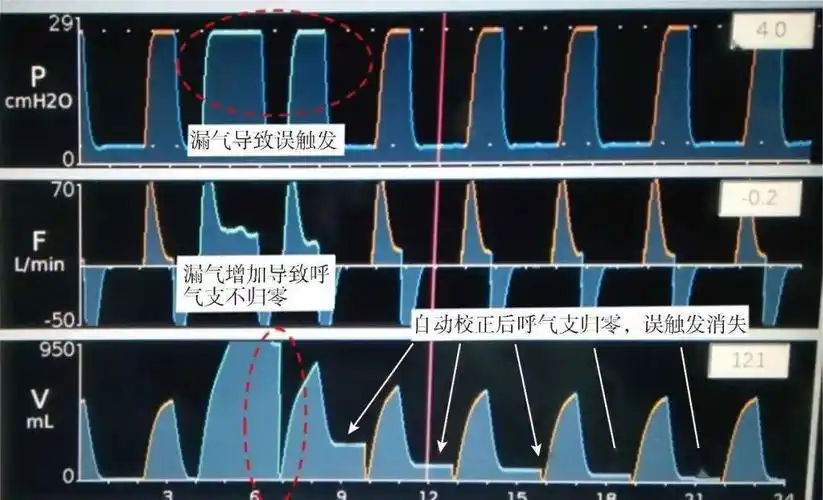 常见异常呼吸波形解读