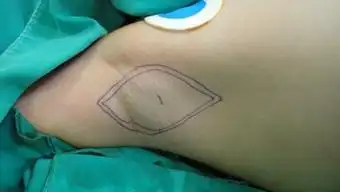 「迷你水刀」治狐臭 9岁香妃小天使焕然「腋」新