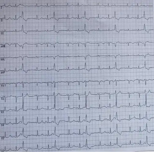 心电图不会看这10个诊断特征需牢记