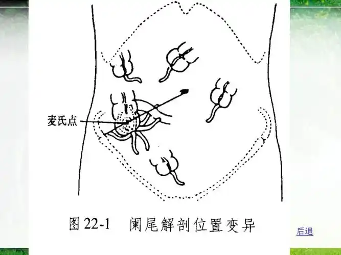 急性阑尾炎病人的护理课件
