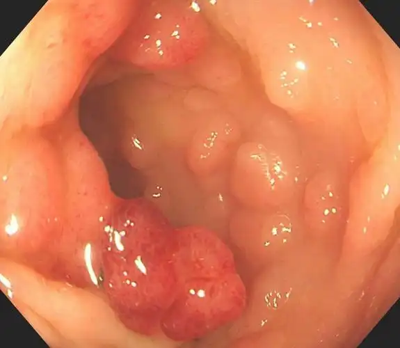 乙状结肠可见密集大小不等息肉,最大约1.5cmx  1.0cm,色红,表面分叶状