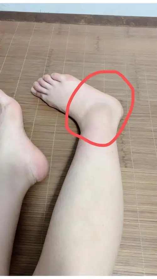 早上走路0869♀15不小心脚崴了,肿成这样989898不过不