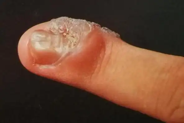 甲周疣是出现在手指或者脚趾指甲周围,甲床,甲下的角化过度,外生性