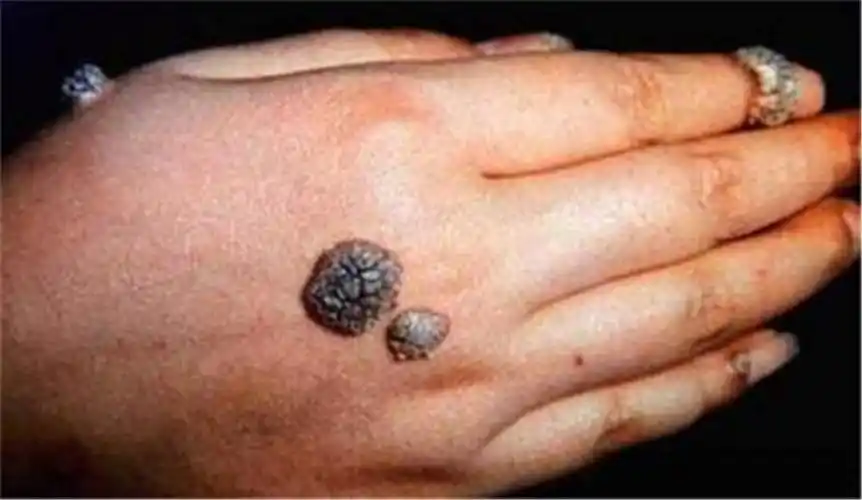 假性湿疣图片_假性湿疣症状表现图片大全_有来医生