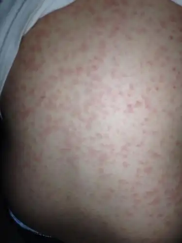 问:请问医生我儿子今天早上全身都长出这样的疹子是什么病毒呢.