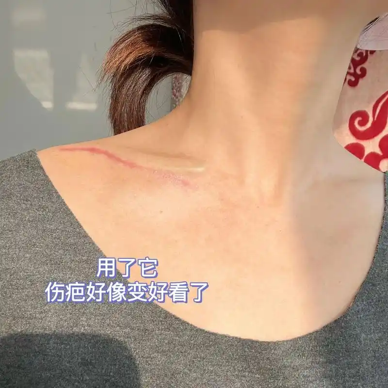 锁骨骨折术后71天|刀口伤疤可以涂碘伏护理  伤筋动骨100天 今天是