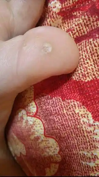 大拇指长了个包 有黑点