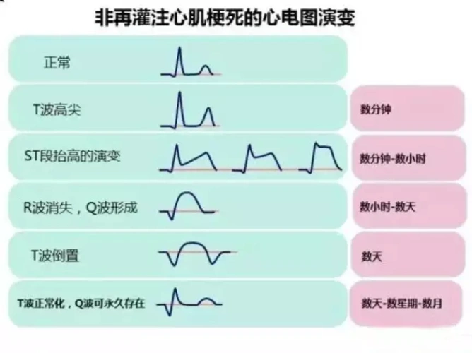学习卡片 速记口诀=轻松看懂心电图