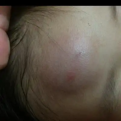 宝宝从床上头着地摔了个大包,怎麼消肿?有没有问题,这个包太大了.