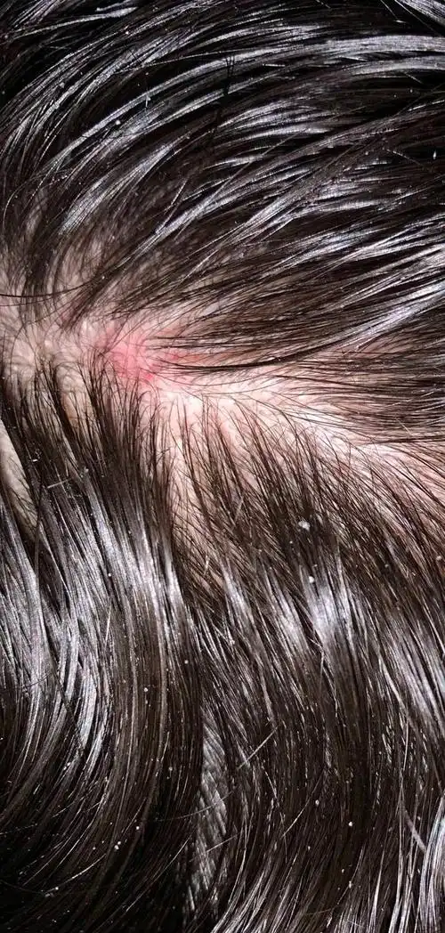 为什么头皮总长"脓包"和"疙瘩"?这4个原因你知道吗?