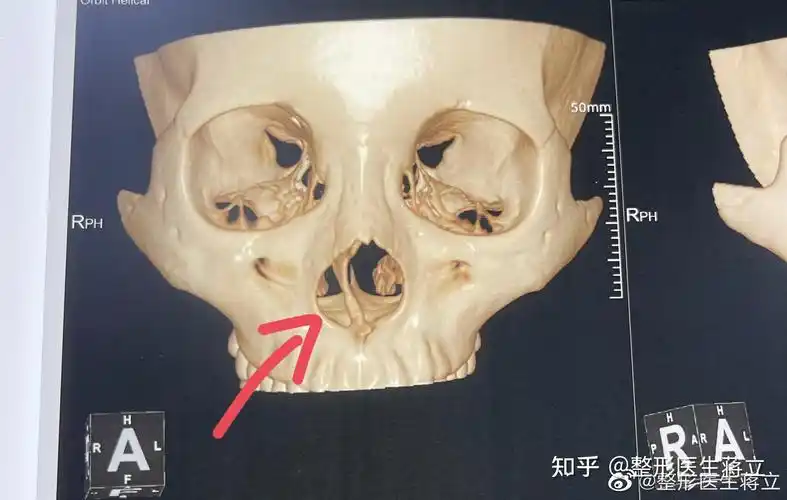 初鼻肥鼻头鼻头大鼻背歪鼻背骨向右侧c型偏曲鼻面坡度左右两侧不对称