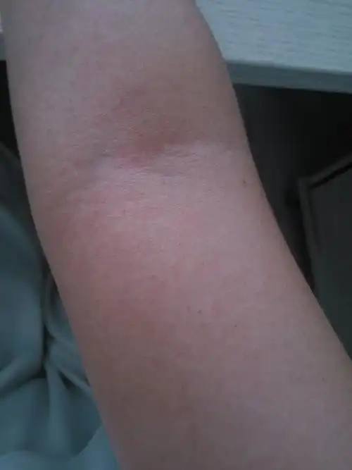 胳膊上突然起了好多血斑,肿么回事,好恐怖呀.