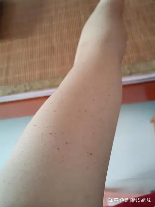 樱桃状血管瘤7年了,被自己丑哭的手臂.