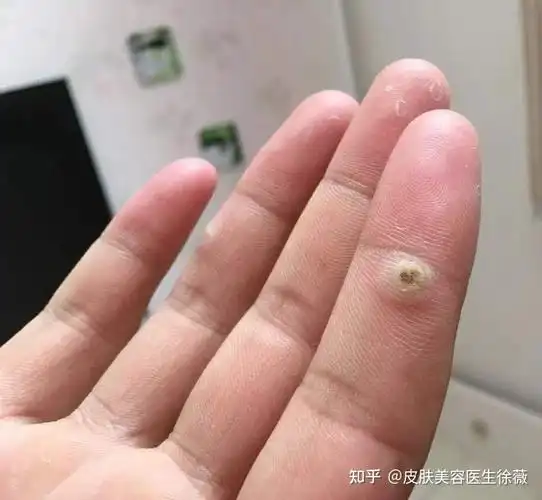 染料激光去疣当天可见水