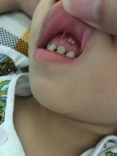 3岁半小宝宝门牙蛀了,然后牙龈上用总长脓包好了两
