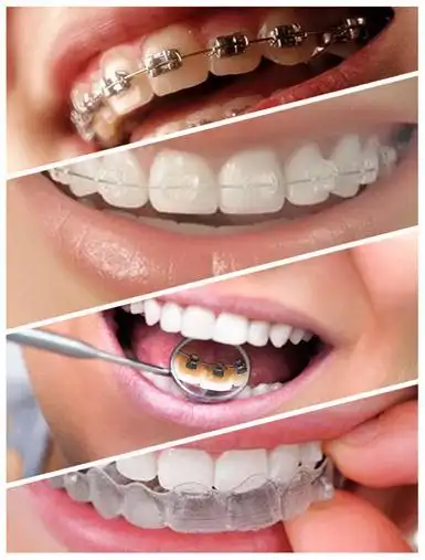 分析哪些牙齿需要矫正,然后用计算机调整牙齿位置,比如一颗牙齿需要