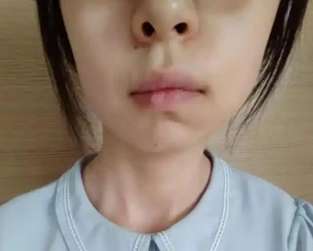 斜颈导致长大后面部畸形 将来,还会出现面部不对称,下颌骨,牙齿畸形等