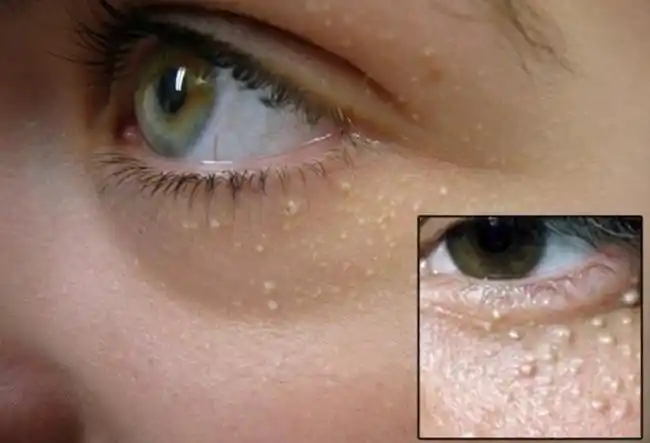 脸上脂肪粒图片 教你快速读懂脂肪粒