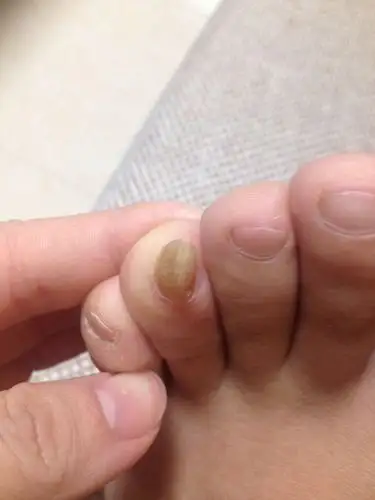 脚指甲变厚变黄,要剪的时候还会很痛.