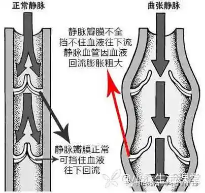兰州天伦生育专家蛋蛋也有曲张精索静脉曲张你需要了解一下