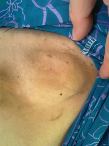 全身多处淋巴结肿大