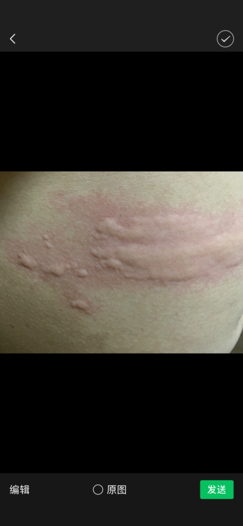 荨麻疹,银屑病等与变态反应有关皮肤病的朋友,要注意不吃海鲜,虾,蟹等