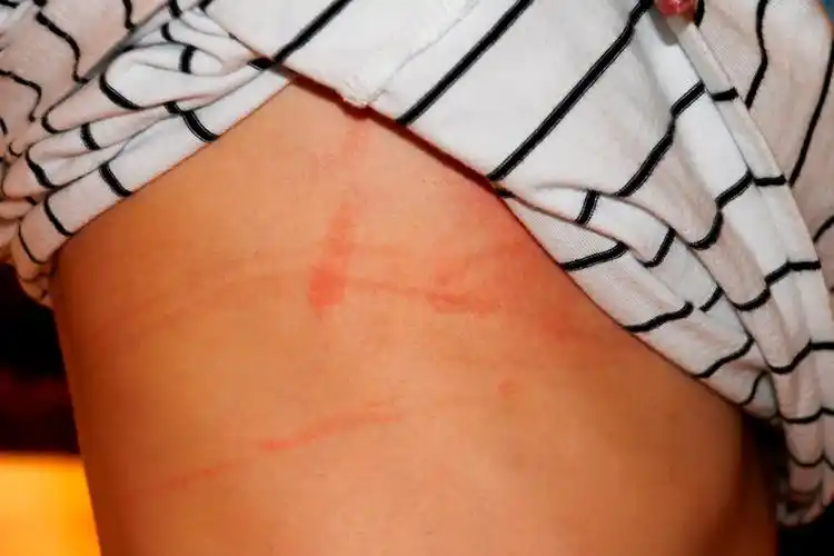 这些都是内衣勒出的红印.