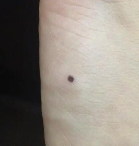 脚上突然长了一个黑痣摸起来是一个突出的