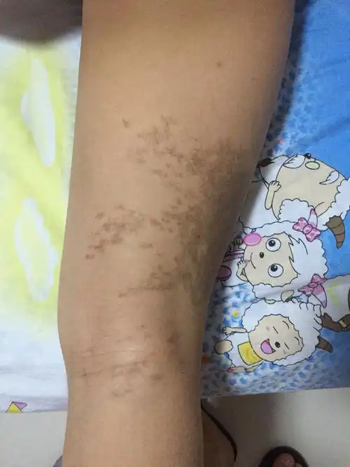 我孩子12岁腿上长出了色斑怎么去除.