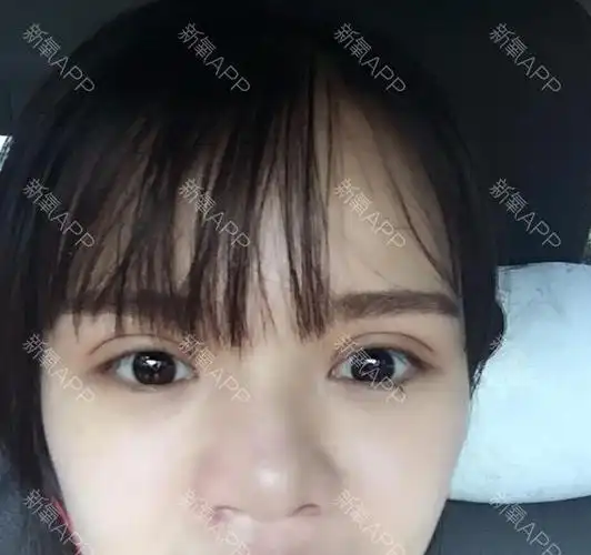 割了双眼皮一周啦很满意哦.分享给大家看看