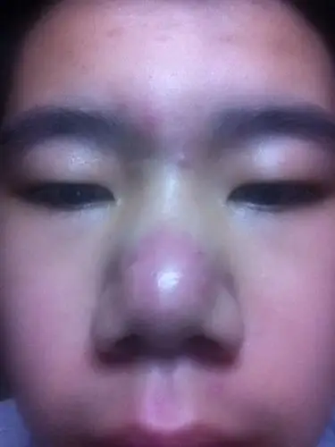 鼻子好像肿一块,有暗疮,该怎么办