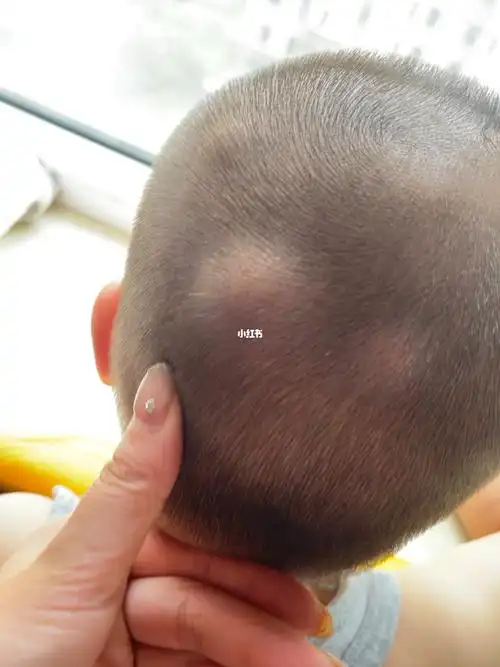 一夜之间好几个包应该是蚊子咬的吧