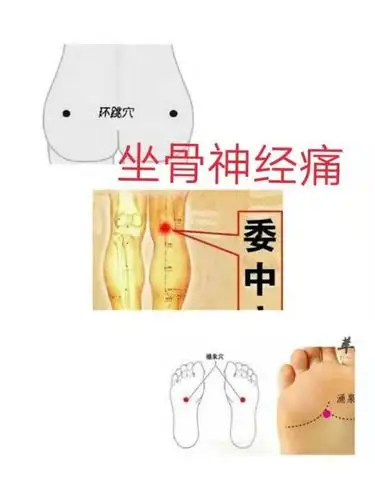 坐骨神经痛穴位图